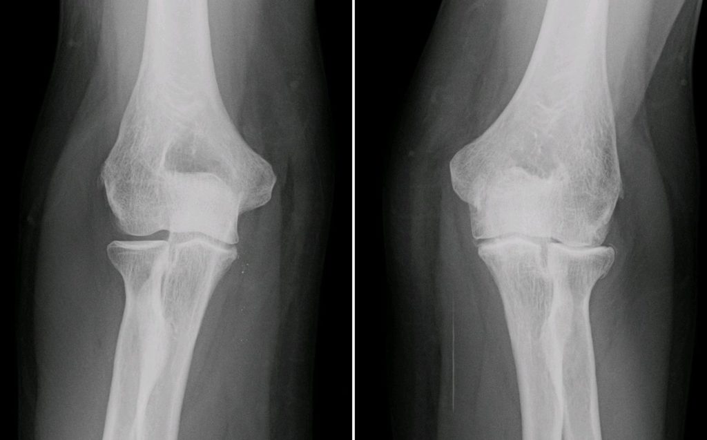 XRay_ElbowOsteoarthritis_RL_AP