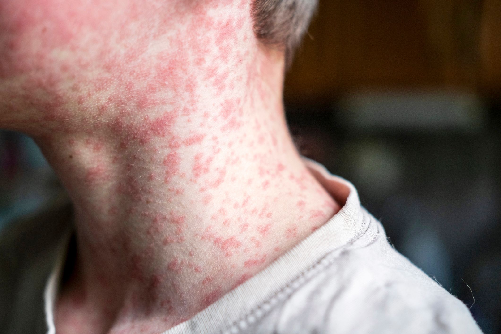 What are the symptoms of measles? How long does the vaccine last?