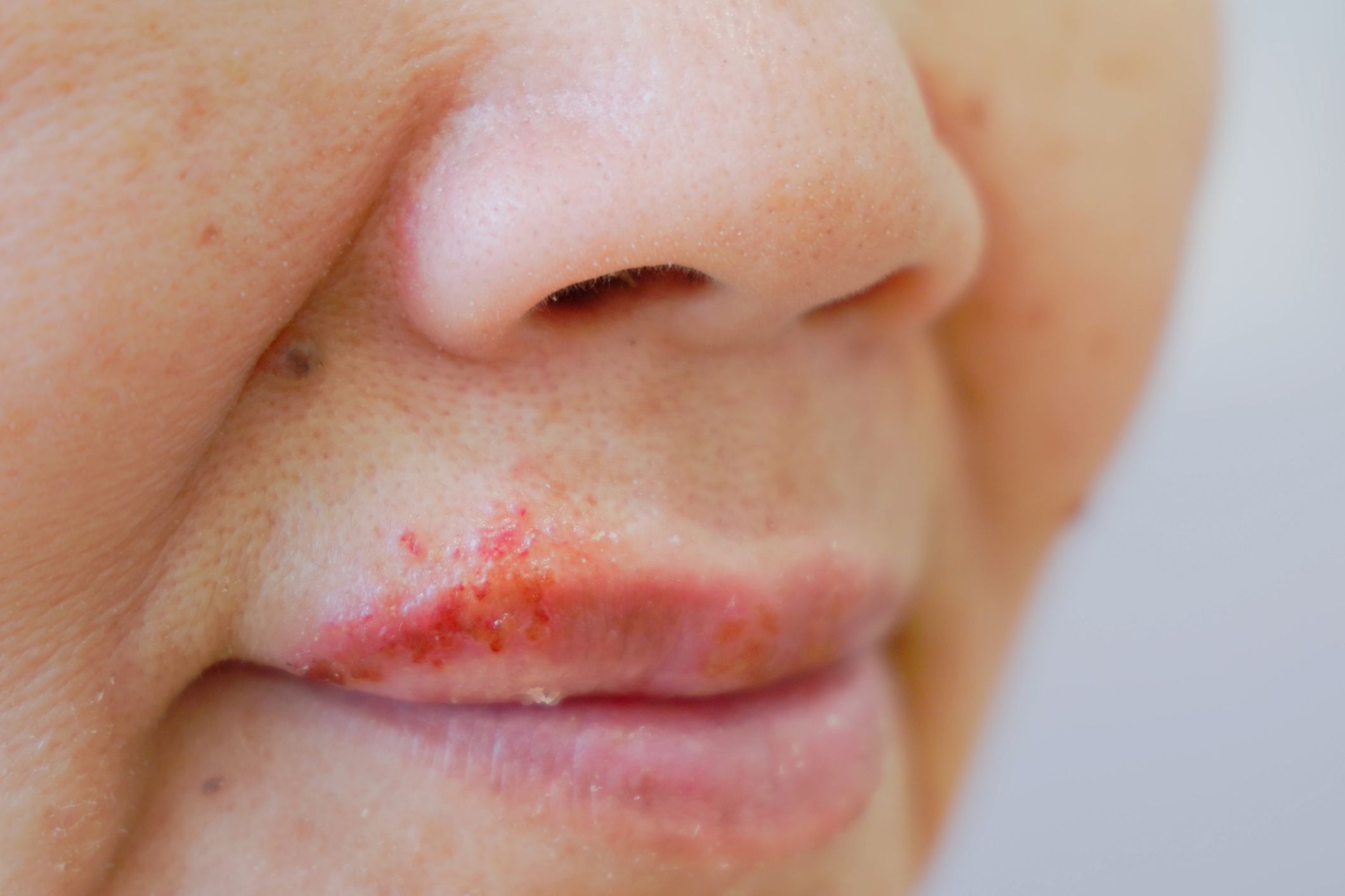 Could the cold sore virus be a hidden cause of Alzheimer’s?