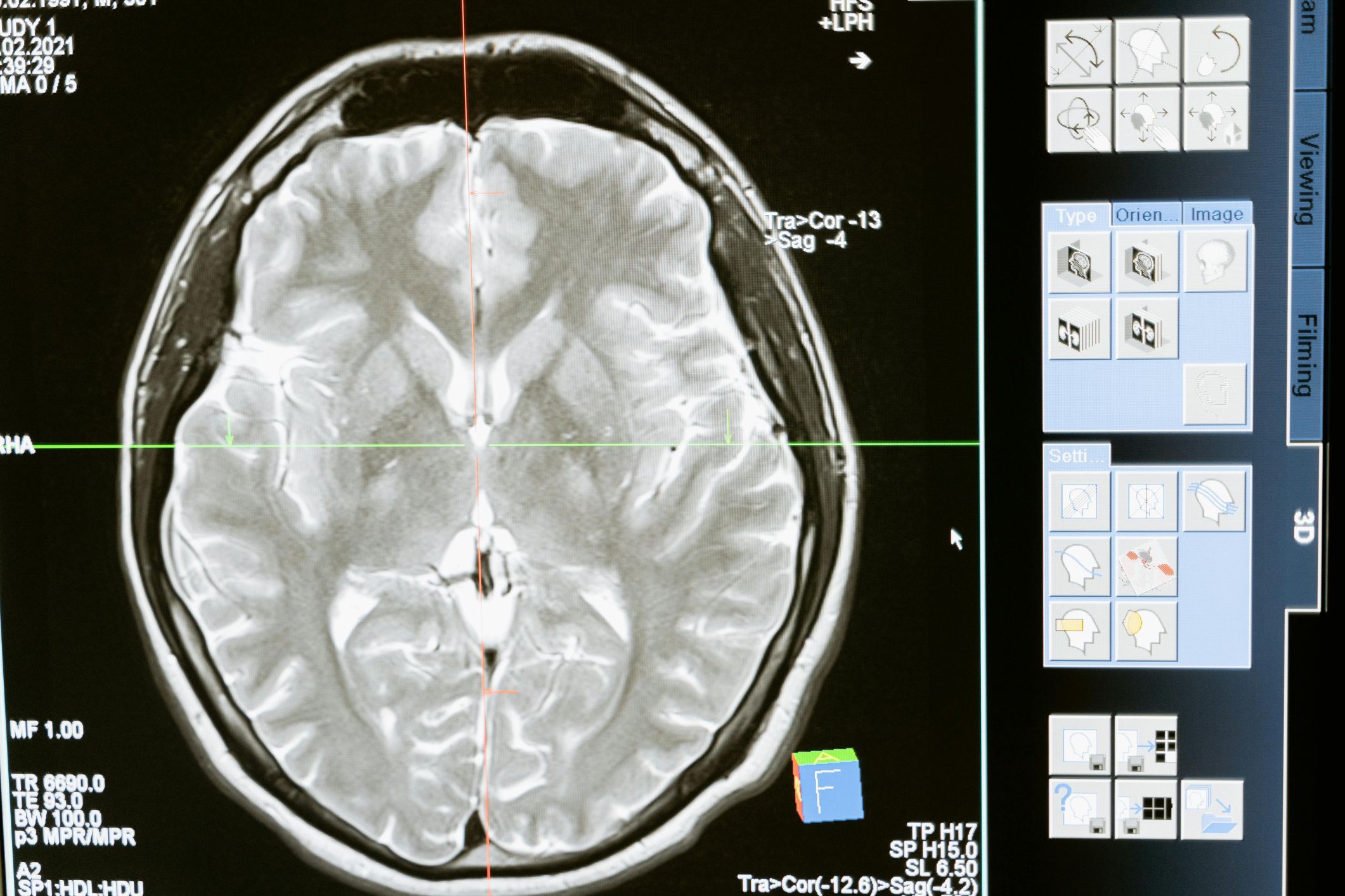 Alzheimer’s disease: New 3min test can spot memory issues – here’s what it can tell you