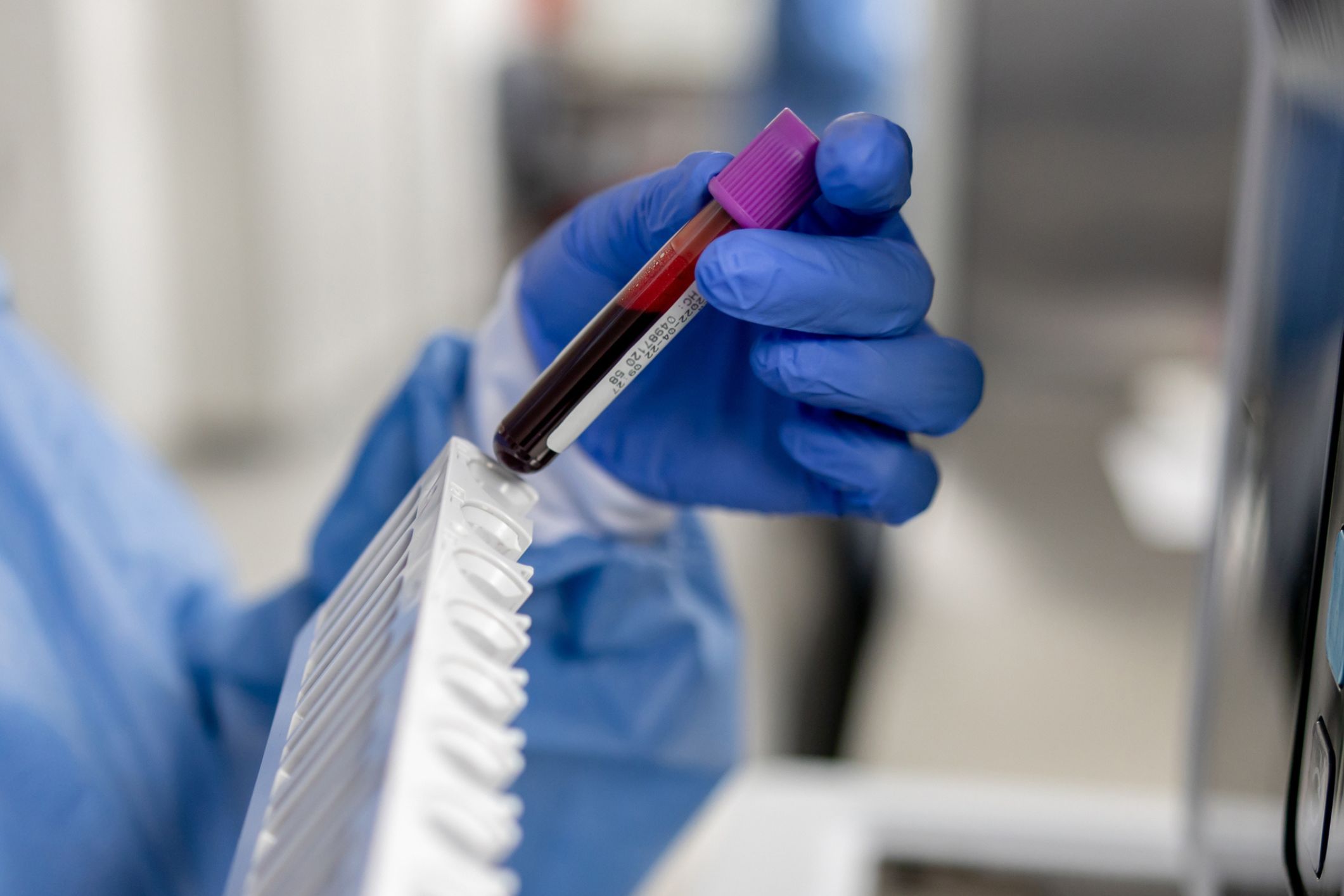Blood biomarkers could detect earliest signs of Alzheimer’s disease – and slow its progression