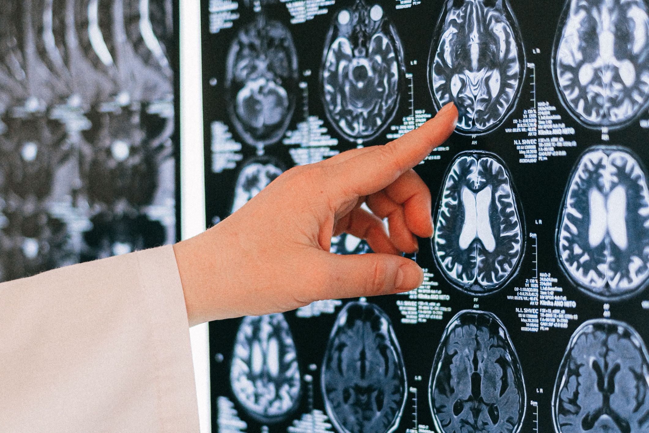 From the footy field to the frontlines: Why MND can't be ignored any longer