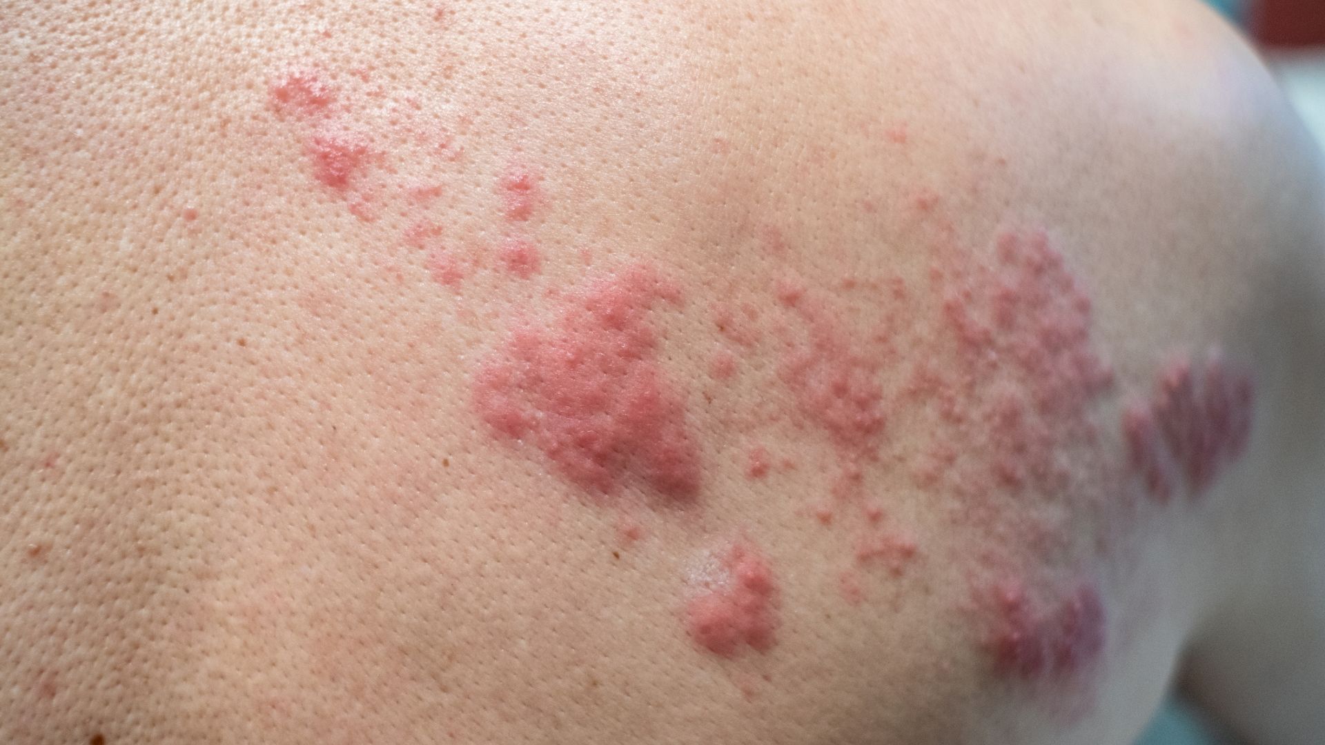 Researchers identify a possible cause of chronic pain after shingles